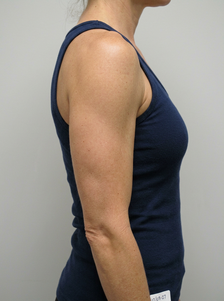 After redSCULPT - Arms