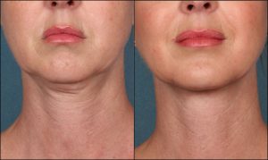 Gentle Glo before and after results - Chin & Neck body contouring League City TX