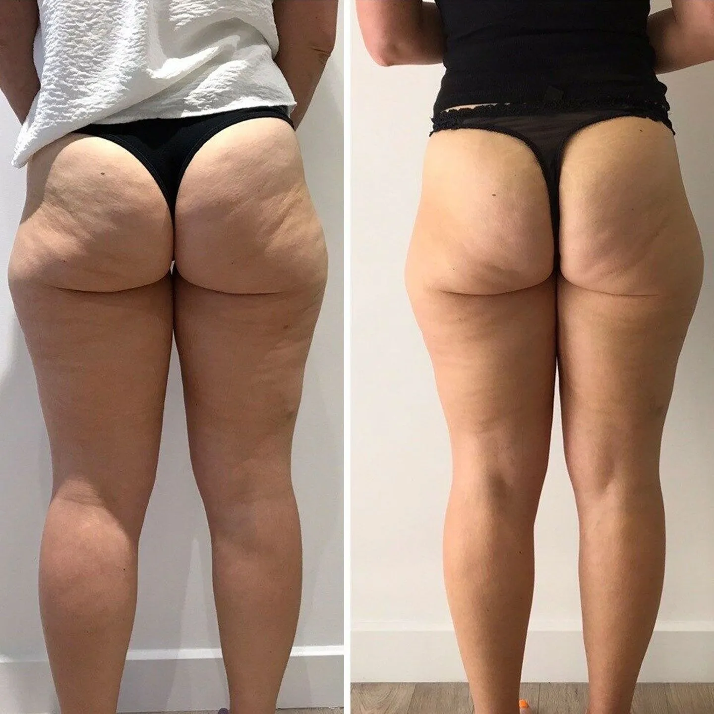 Gentle Glo before and after results - Thighs & Glutes body contouring League City TX